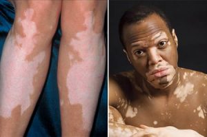 doenças de pele